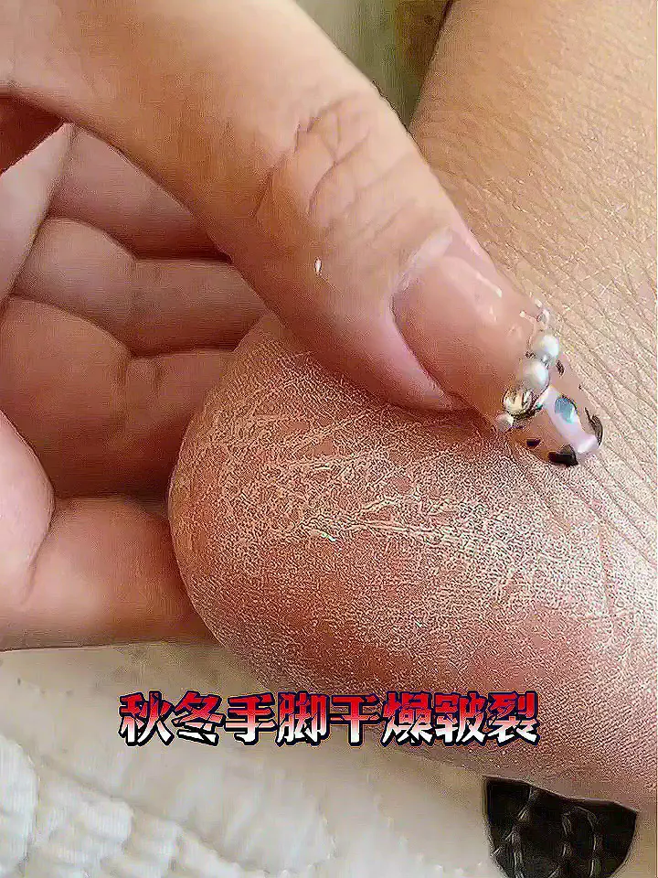 20💰出头的手足干裂膏真的爱惨了！
